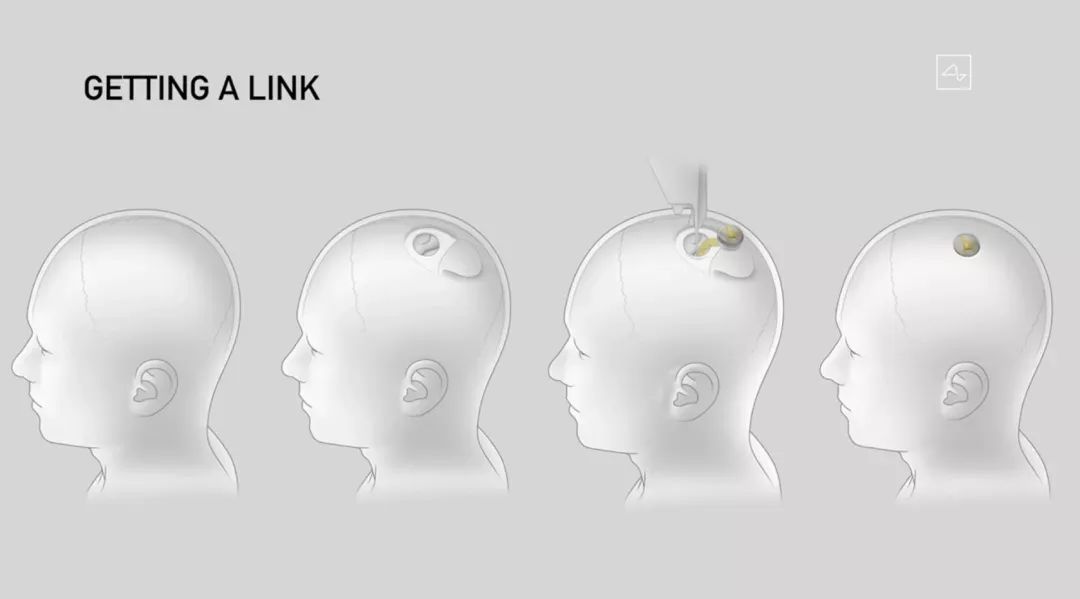 馬斯克發(fā)布腦機(jī)接口重大突破！藍(lán)牙連接，一小時植入，終極目標(biāo)是實(shí)現(xiàn)數(shù)字永生！